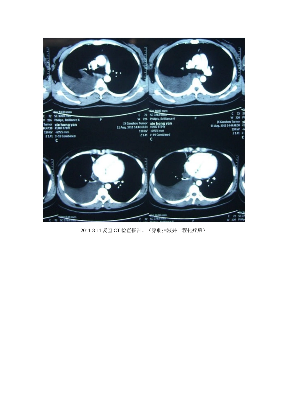 癌性胸腔积液临床案例剖析1_第2页