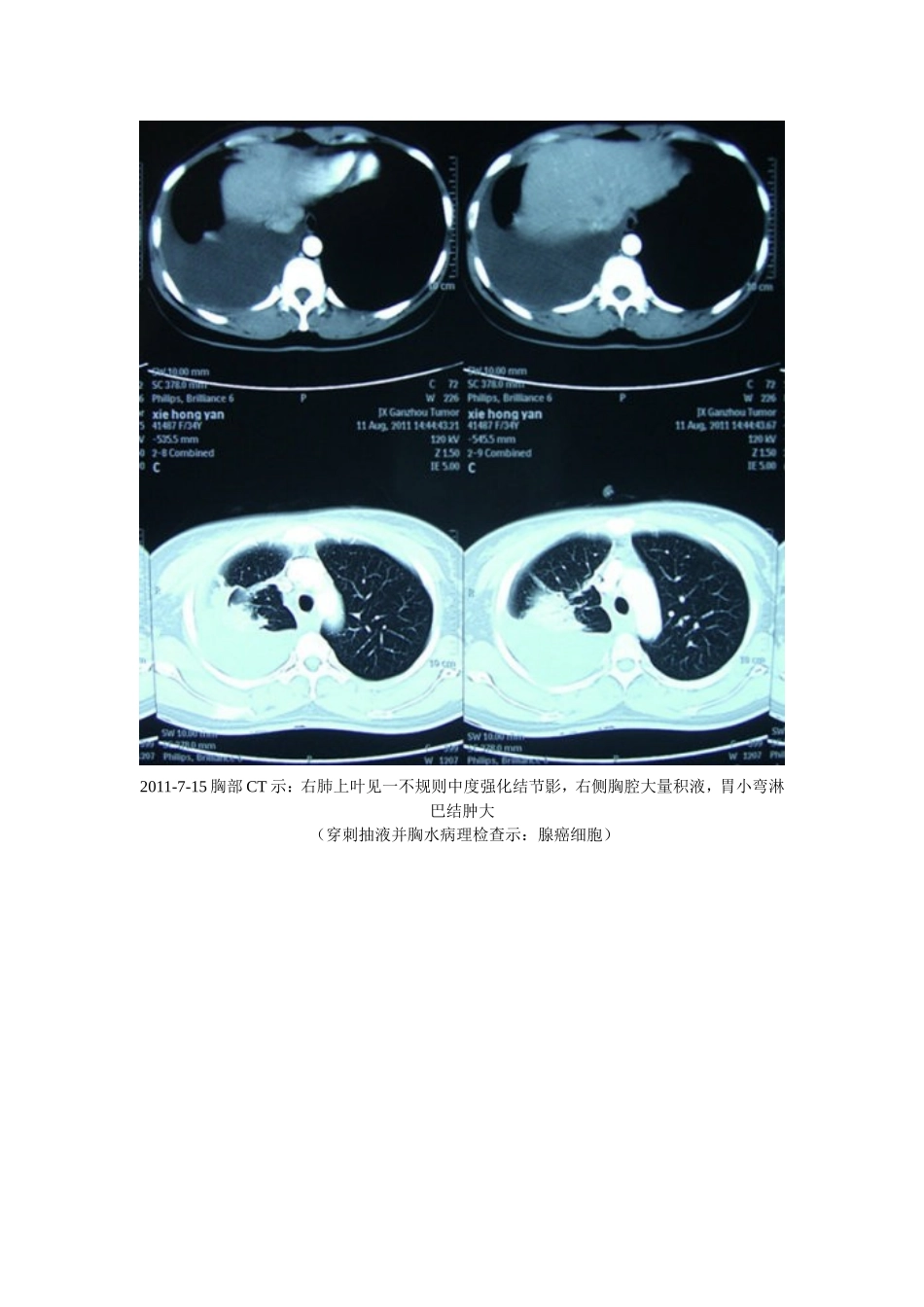 癌性胸腔积液临床案例剖析1_第3页