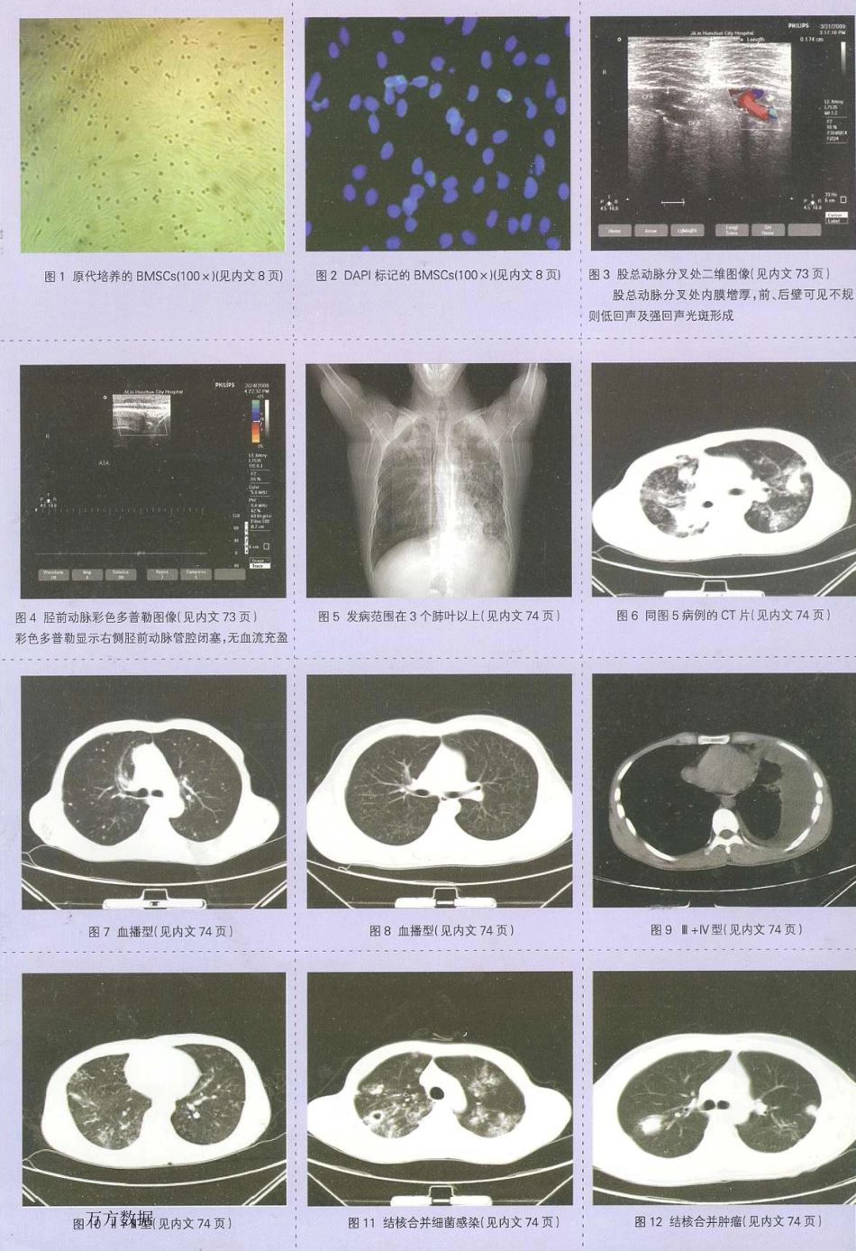 彩色多普勒分析糖尿病足的下肢动脉病变_第3页