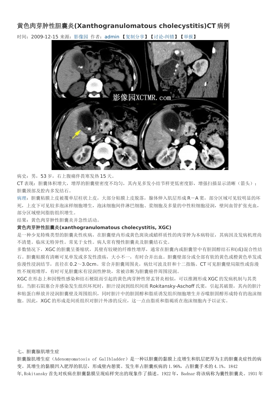 胆囊慢性炎性病变_第1页