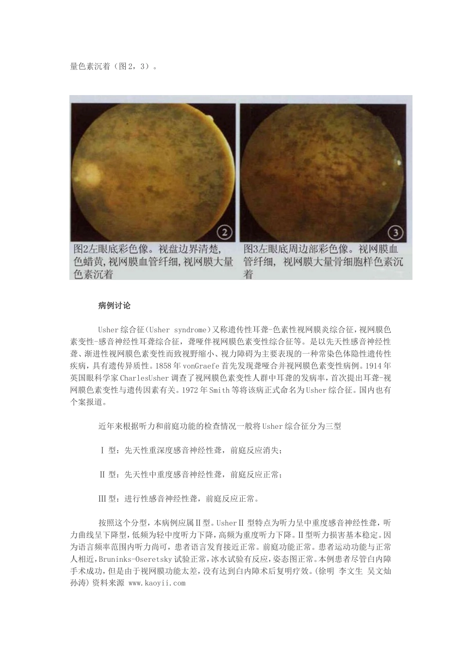 Usher综合征一例_第2页