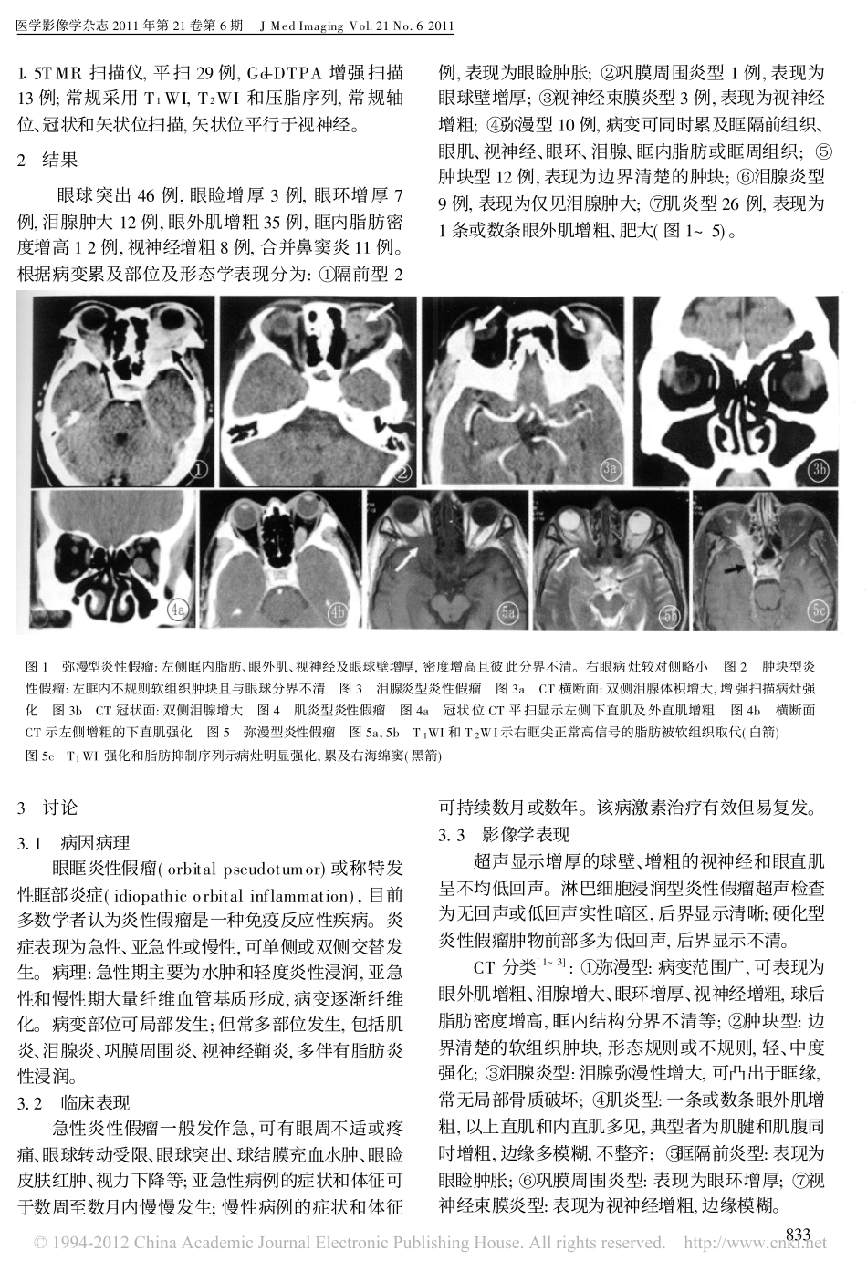 CT_MRI在眼眶炎性假瘤的诊断价值_第2页