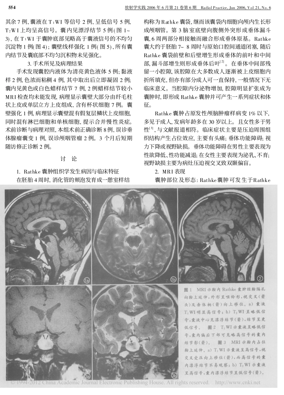 鞍区Rathke囊肿MRI诊断_第2页