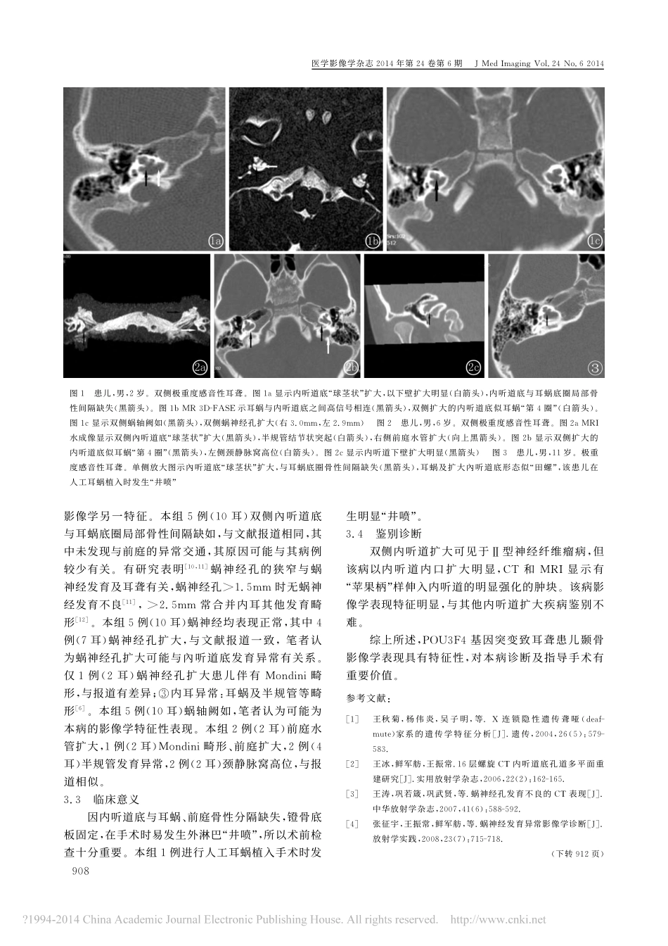 POU3F4基因突变致耳聋的HRCT和MRI表现_张宗建_第3页
