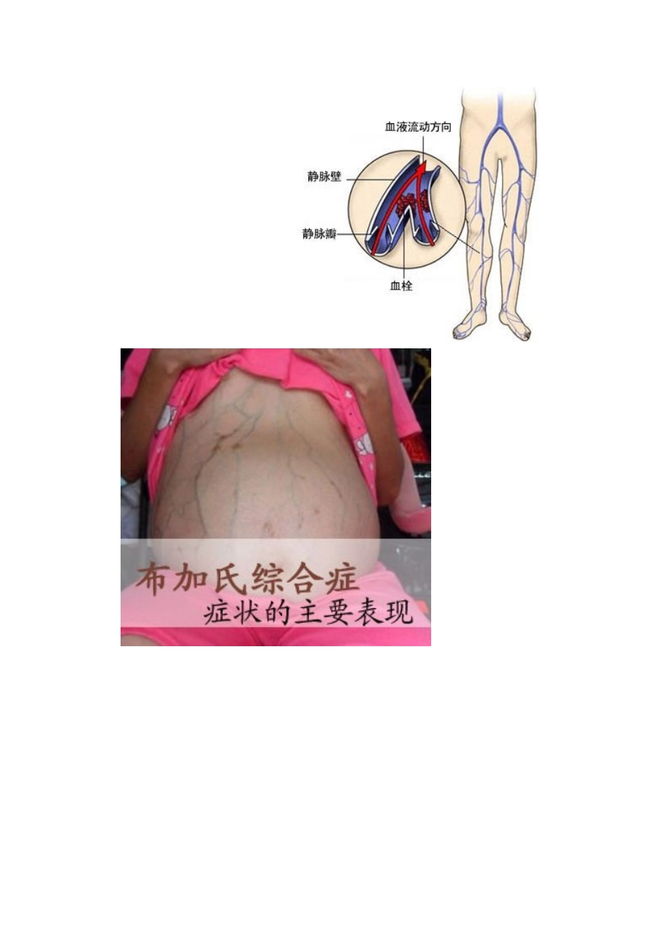 布加综合征的护理_第3页
