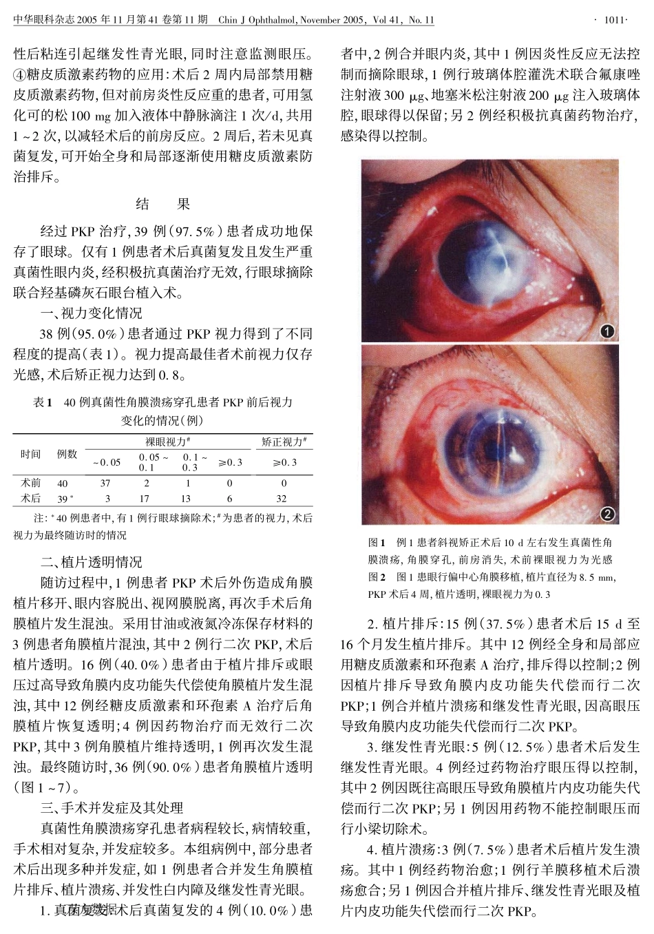 穿透性角膜移植术治疗真菌性角膜溃疡穿孔_第3页