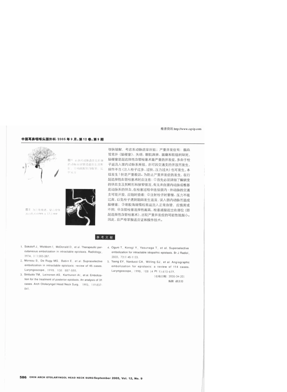 超选择性血管栓塞术疗重鼻出血治严_第3页