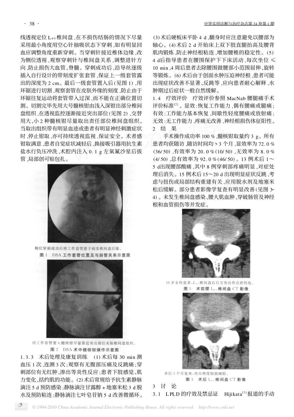 侧入路经皮穿刺腰椎间盘髓核摘除术_第2页