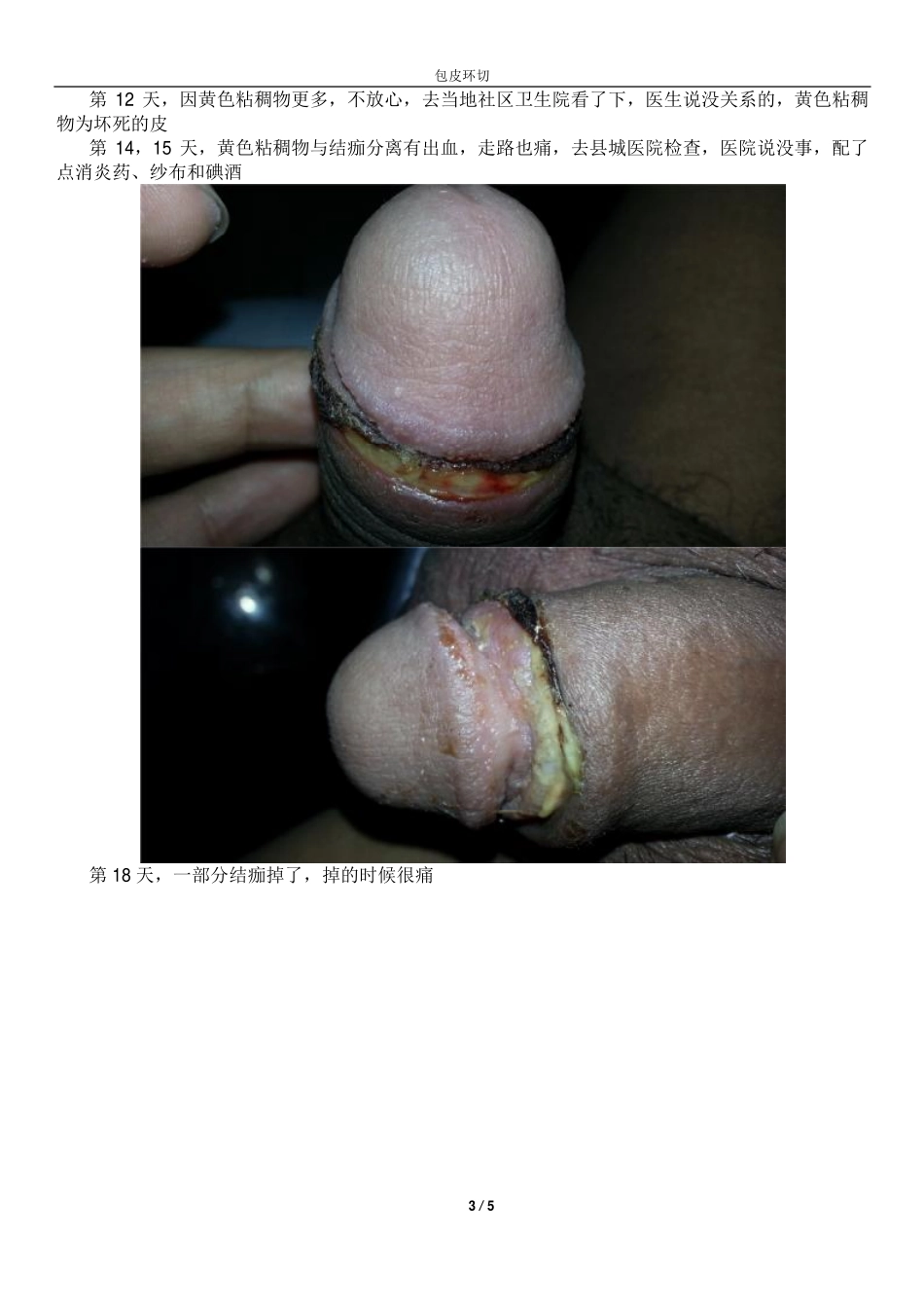 包皮环切(患者图文解说)_第3页
