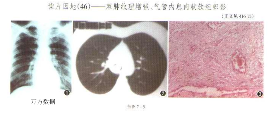第46例——双肺纹理增强、气管内息肉状软组织影_第2页