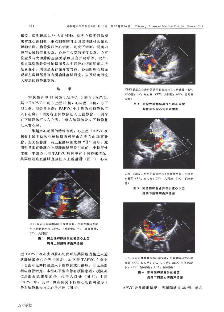 超声心动图诊断肺静脉异位引流_第2页
