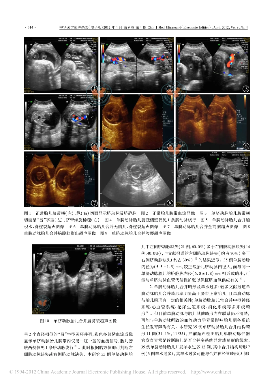 产前超声诊断胎儿单脐动脉及临床分析_第2页