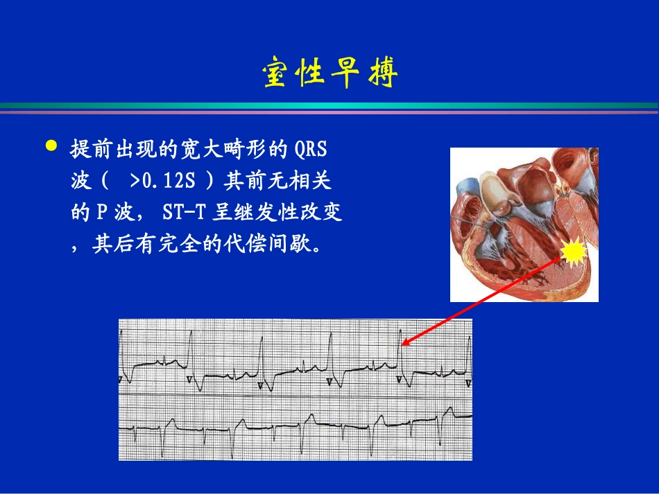 常见室性快速心律失常的识别及处理_第3页