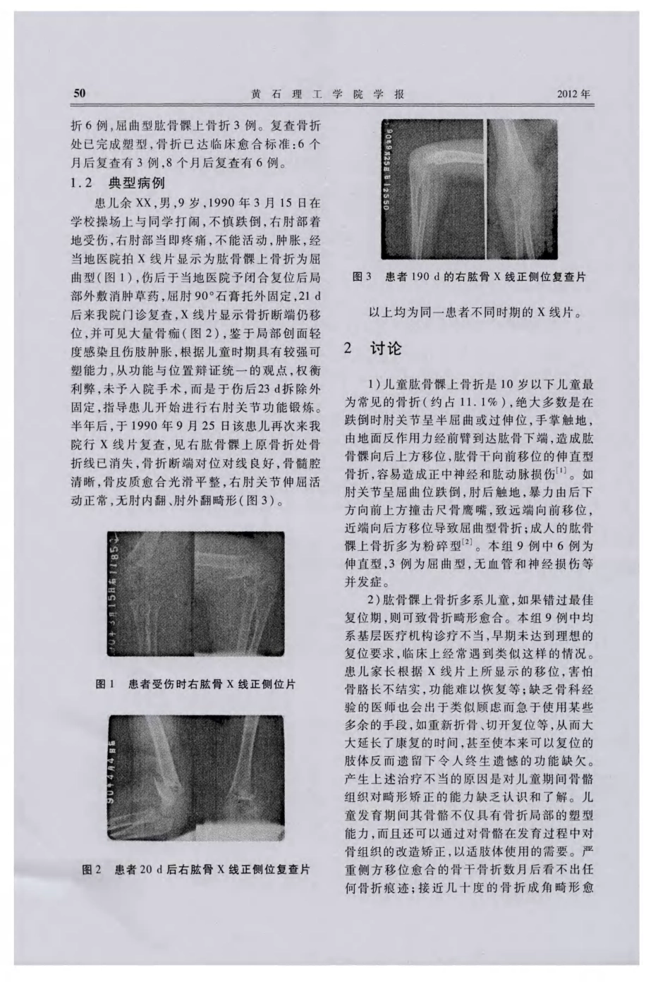从儿童肱骨髁上骨折畸形愈合看儿童骨骼组织的塑型能力_第2页