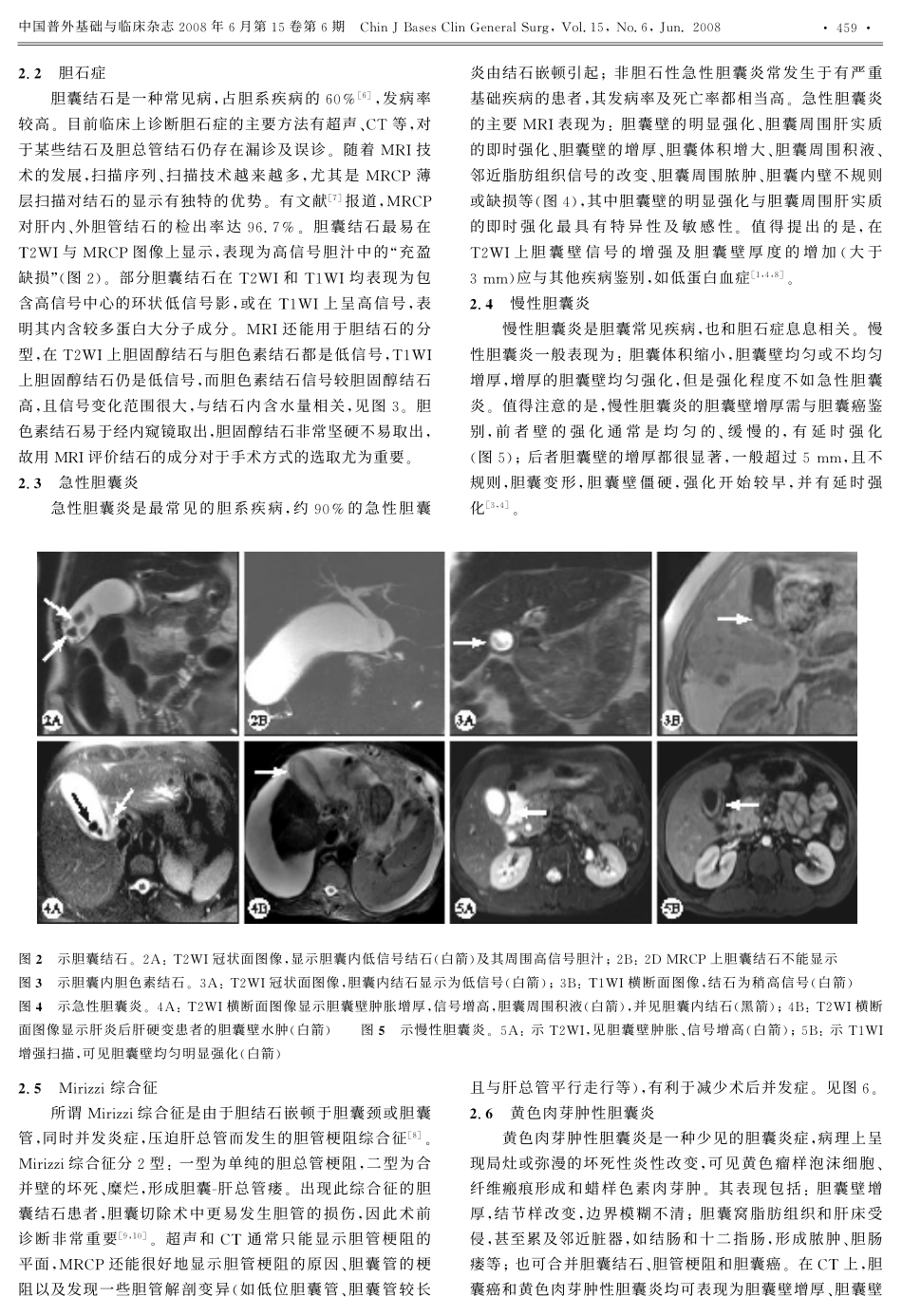 胆囊的MRI评价_第2页