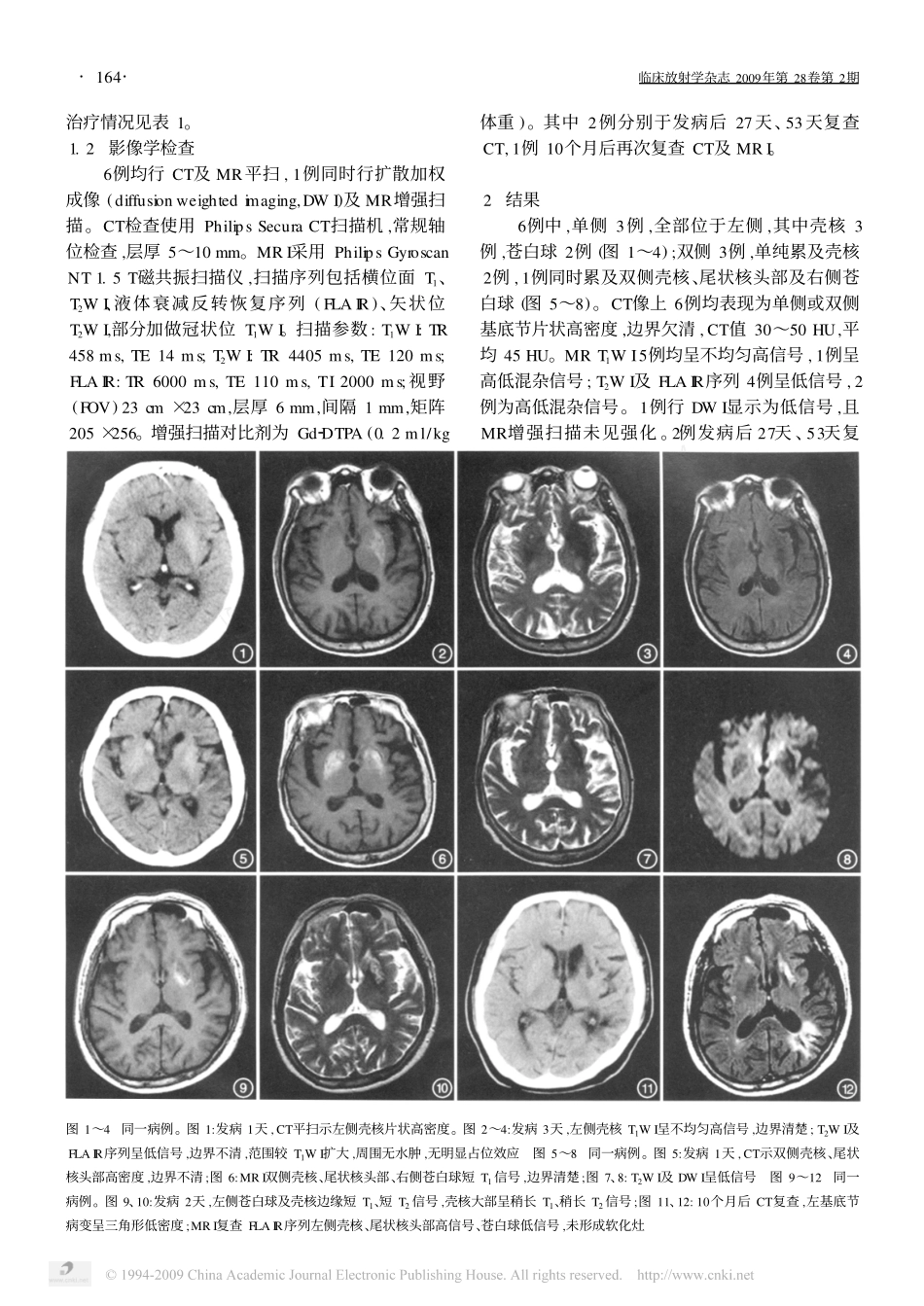 非酮症性高血糖脑部影像学表现_第2页