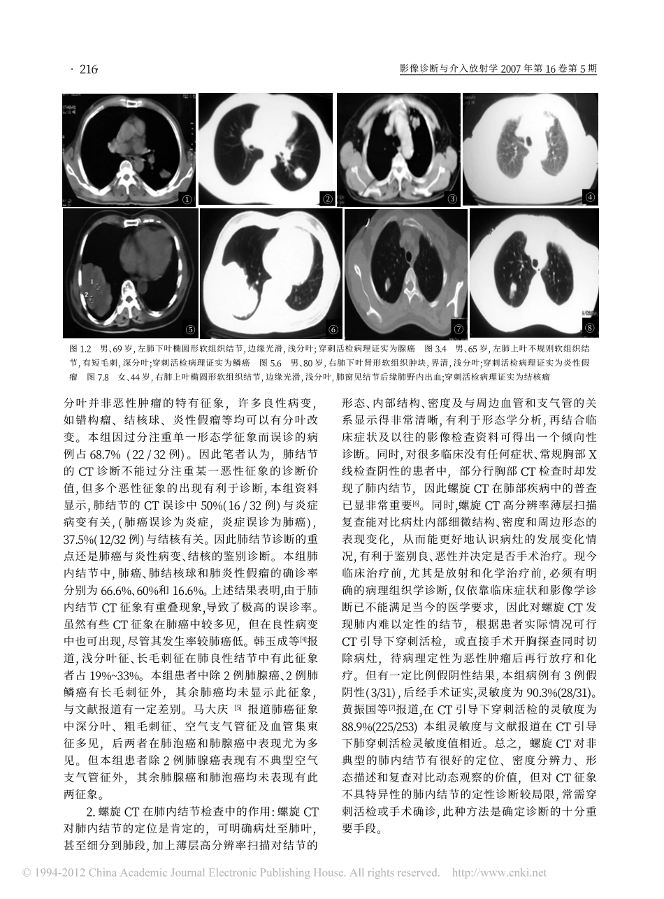 非典型肺结节的螺旋CT征象与病理对照分析_王开福_第3页