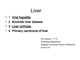 血吸虫性肝硬变