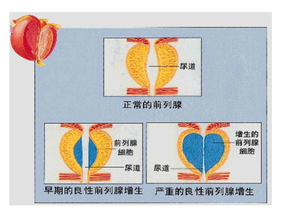 药综-十四章-前列腺增生症_第3页