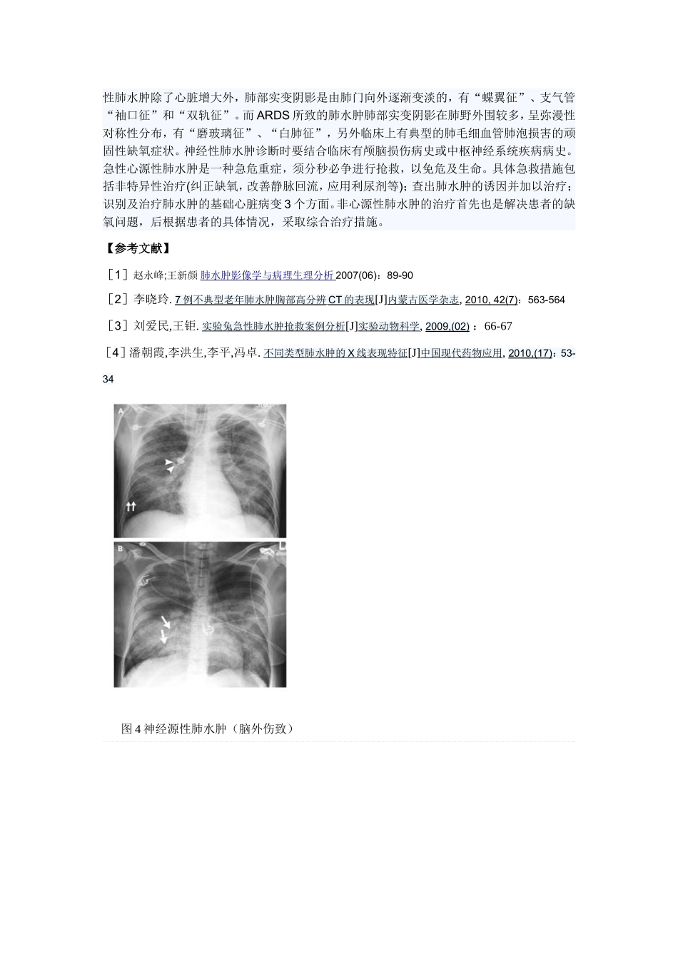 肺水肿X线征象分析1_第3页