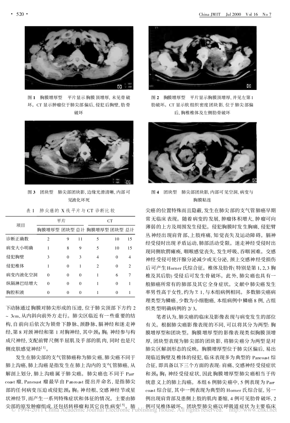 肺尖癌的临床及影像诊断_第2页