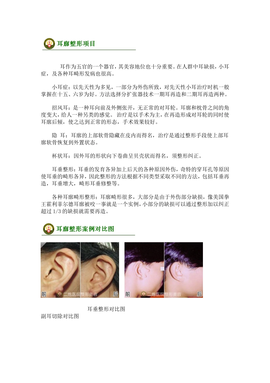 耳廓整形手术_第2页