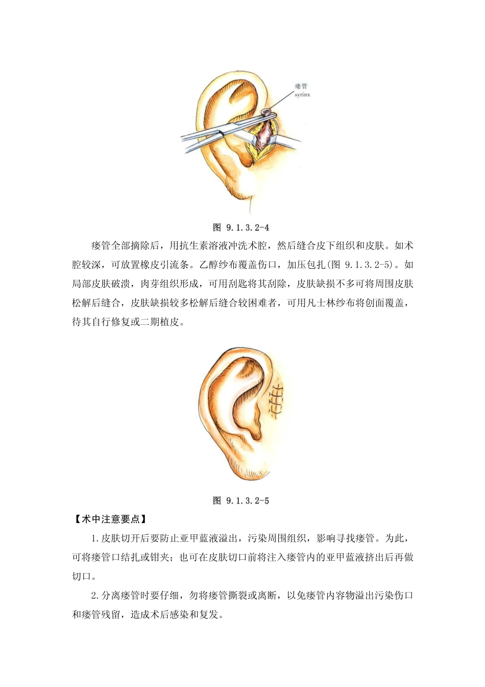 耳前瘘管摘除术[1]_第3页