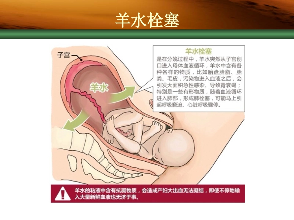 羊水栓塞的早期识别与诊治_第3页