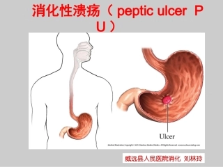 消化性溃疡刘林玲