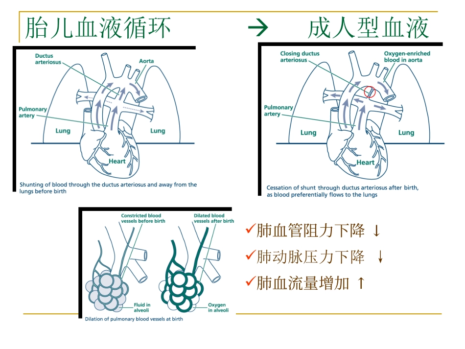 新生儿肺动脉高压_第3页
