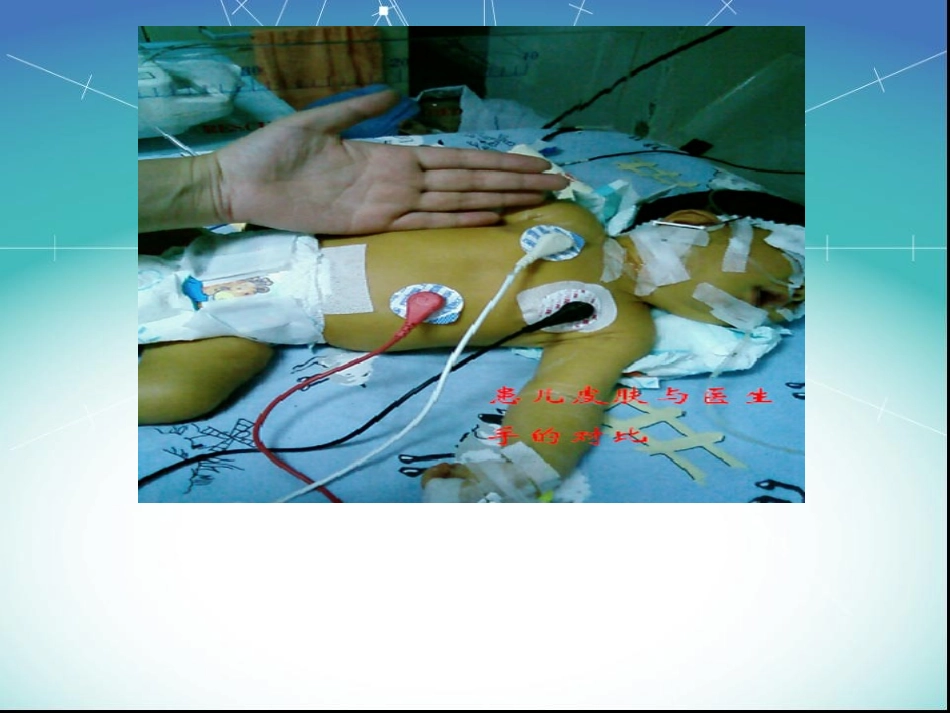 新生儿溶血病-(1)_第1页