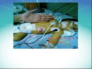 新生儿溶血病-(1)