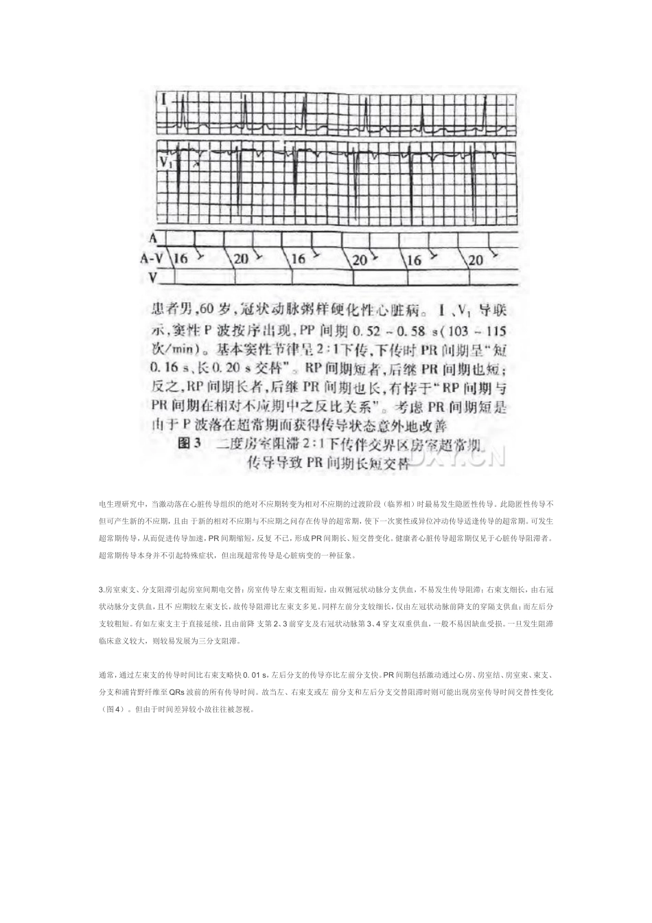 房室间期的电交替一例_第3页