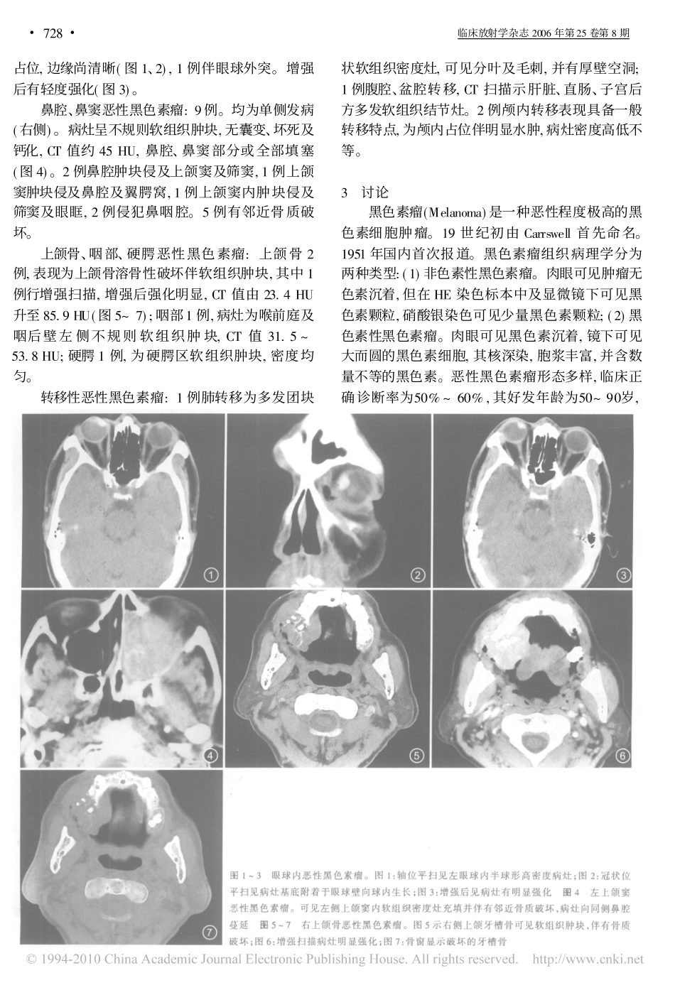 恶性黑色素瘤的CT诊断_第2页