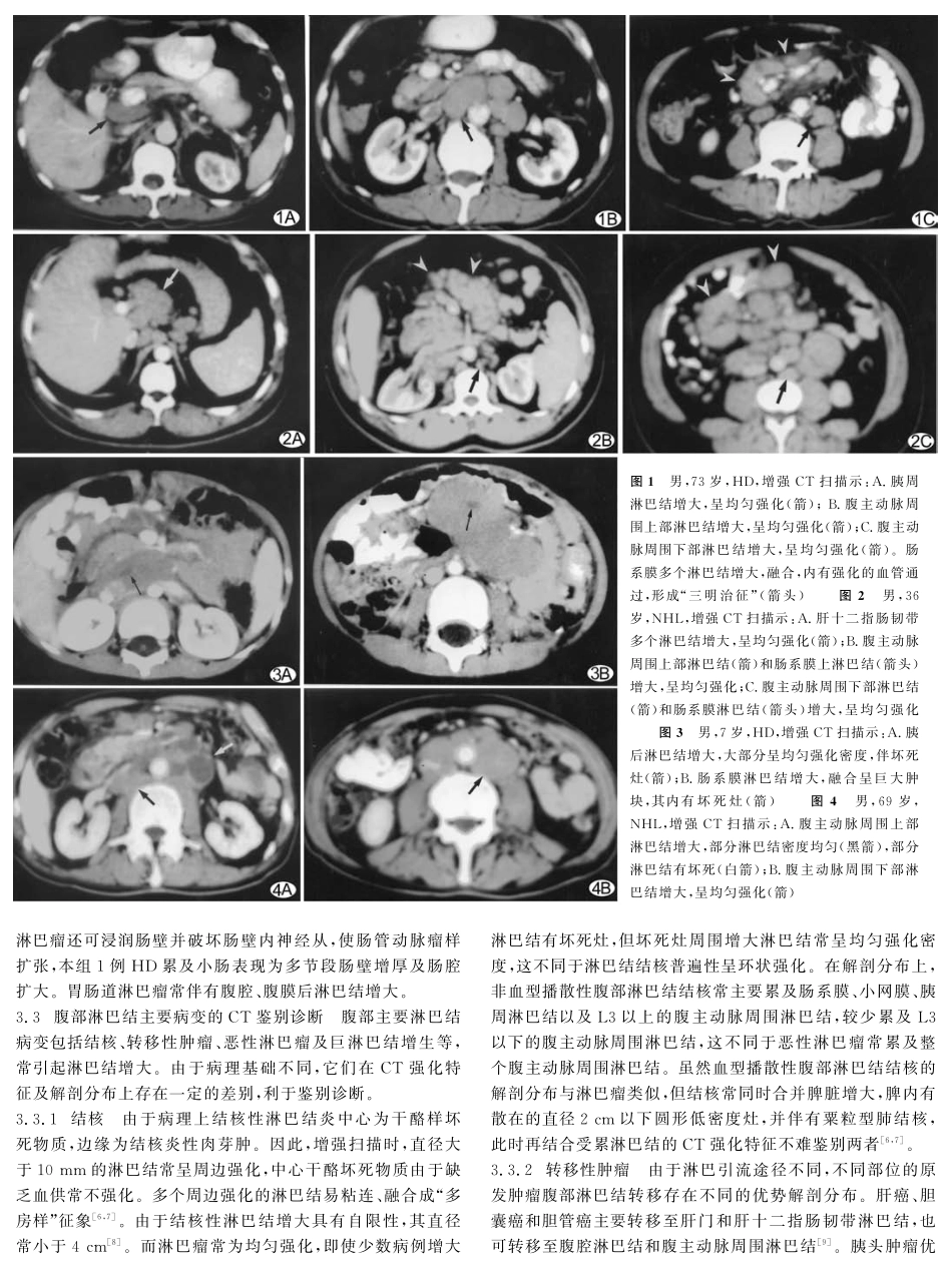 恶性淋巴瘤累及腹腔、腹膜后淋巴结的 多层螺旋CT强化表现特征_第3页