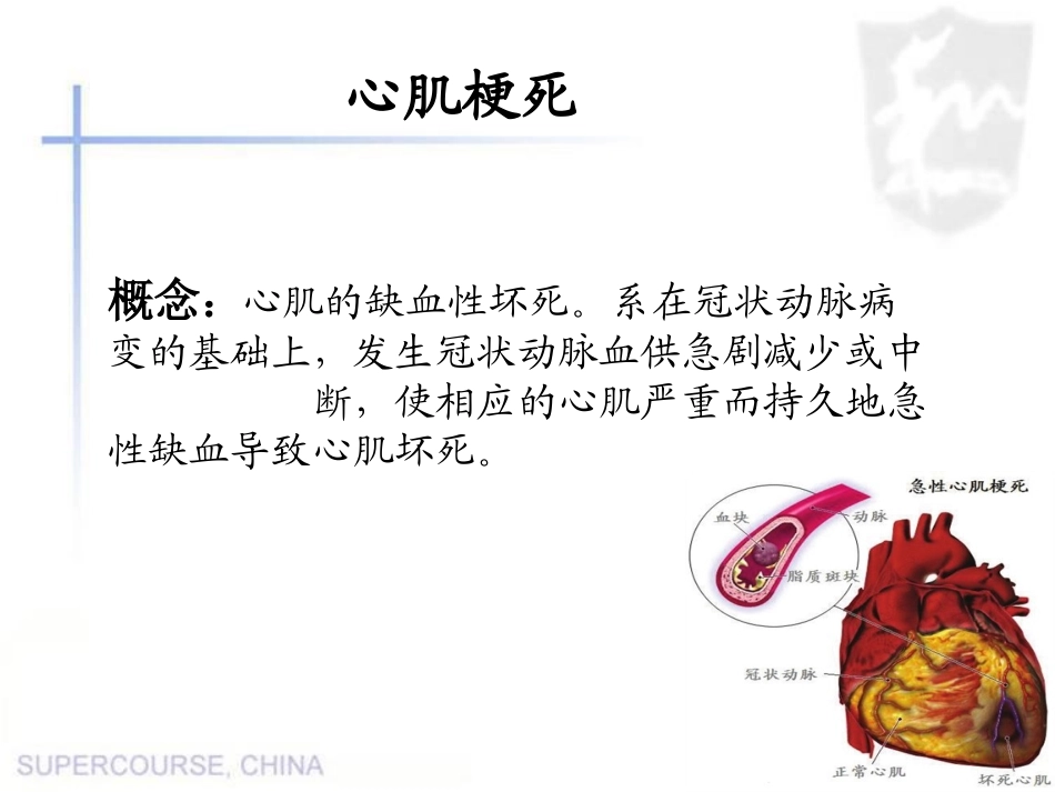 心肌梗死教学查房_第3页