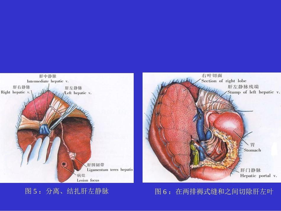 左半肝切除术1汇总_第3页