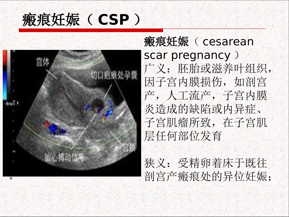 子宫瘢痕妊娠.._第2页