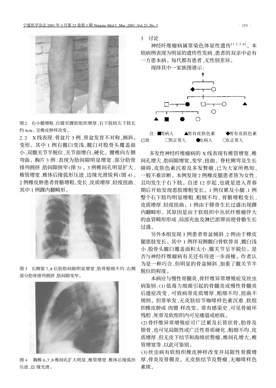 多发性神经纤维瘤的X线诊断_第2页
