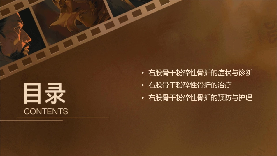 右股骨干粉碎性骨折课件_第2页
