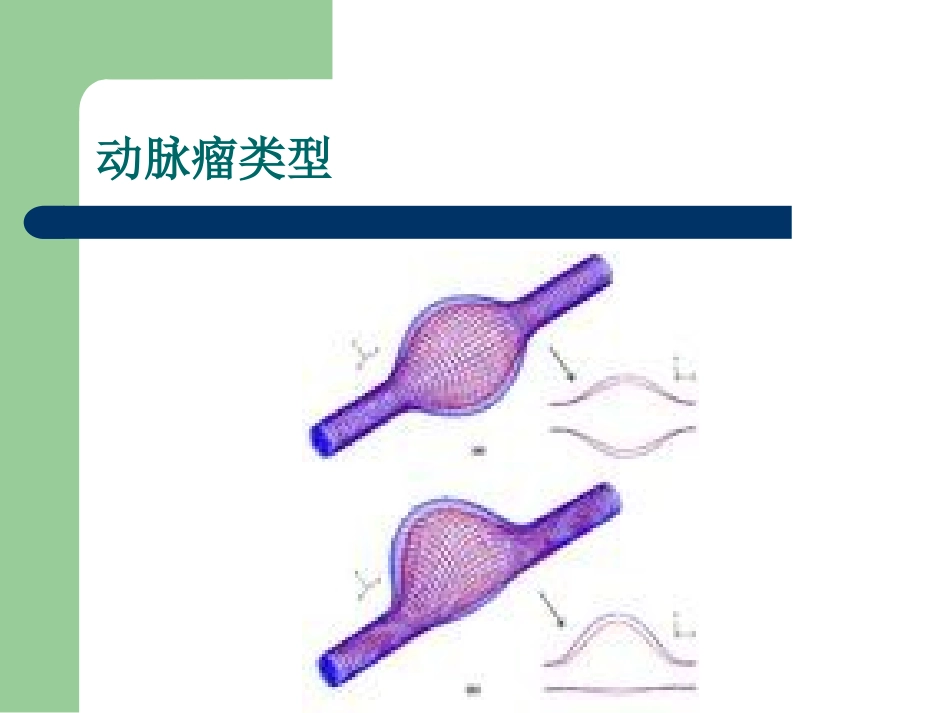 动 脉 瘤1_第3页