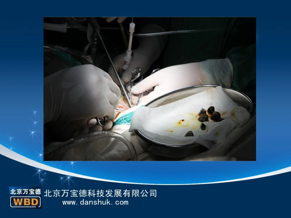 冬季胆结石患者应该注意什么问题？_第2页