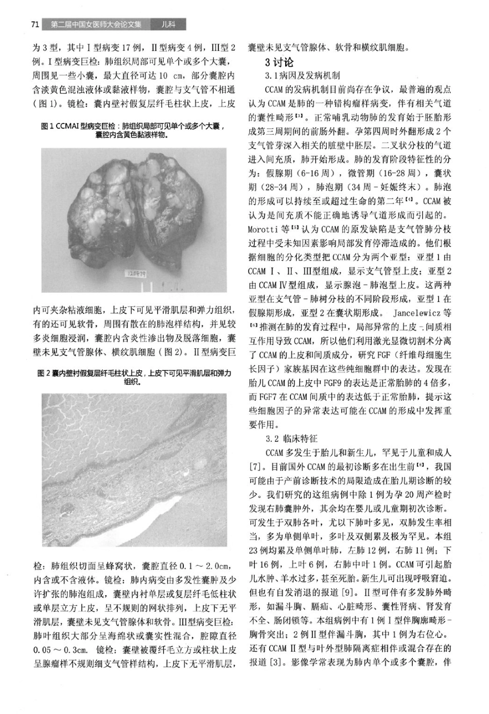 儿童肺先天性囊性腺瘤样畸形23例的临床病理分析_第2页