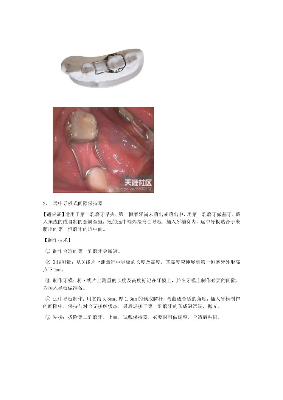 儿童乳牙牙体缺损修复术及缺隙保持器_第3页