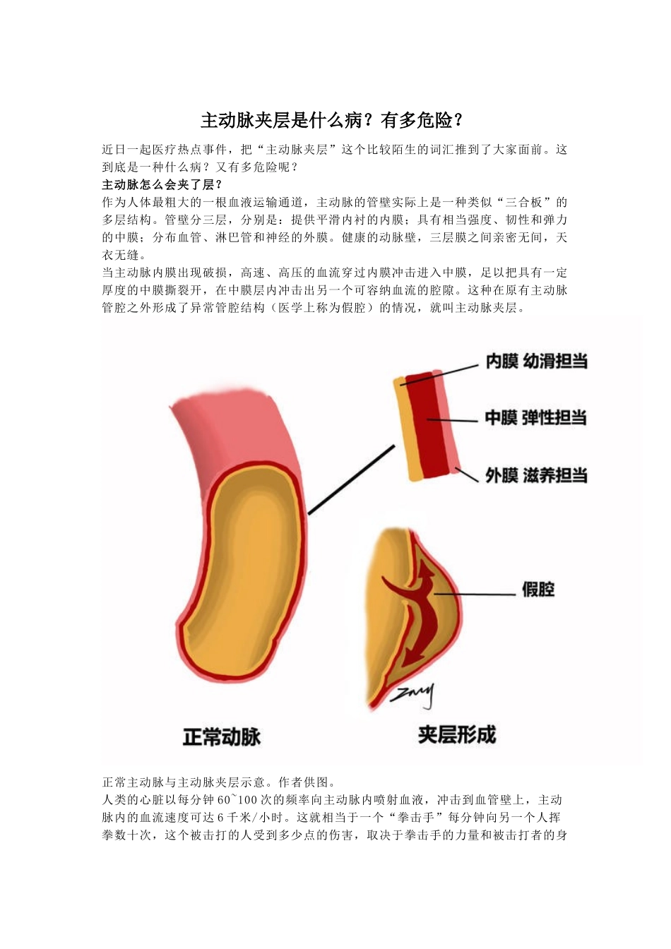 主动脉夹层是什么病？有多危险？_第1页