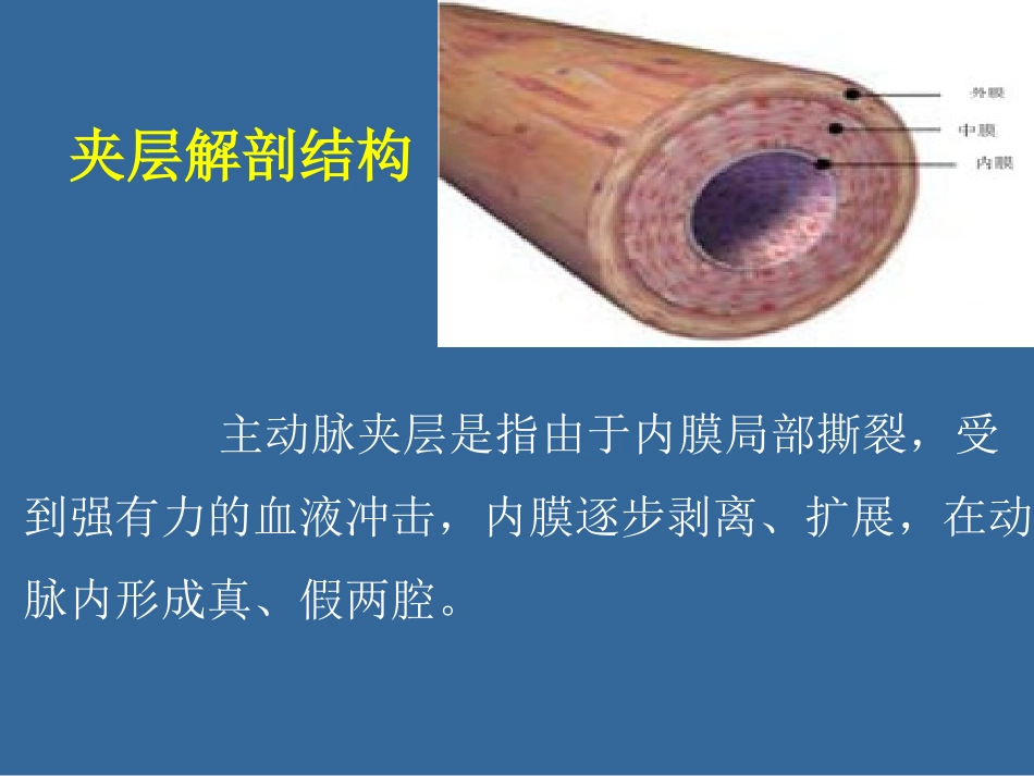 主动脉夹层与高血压_第3页