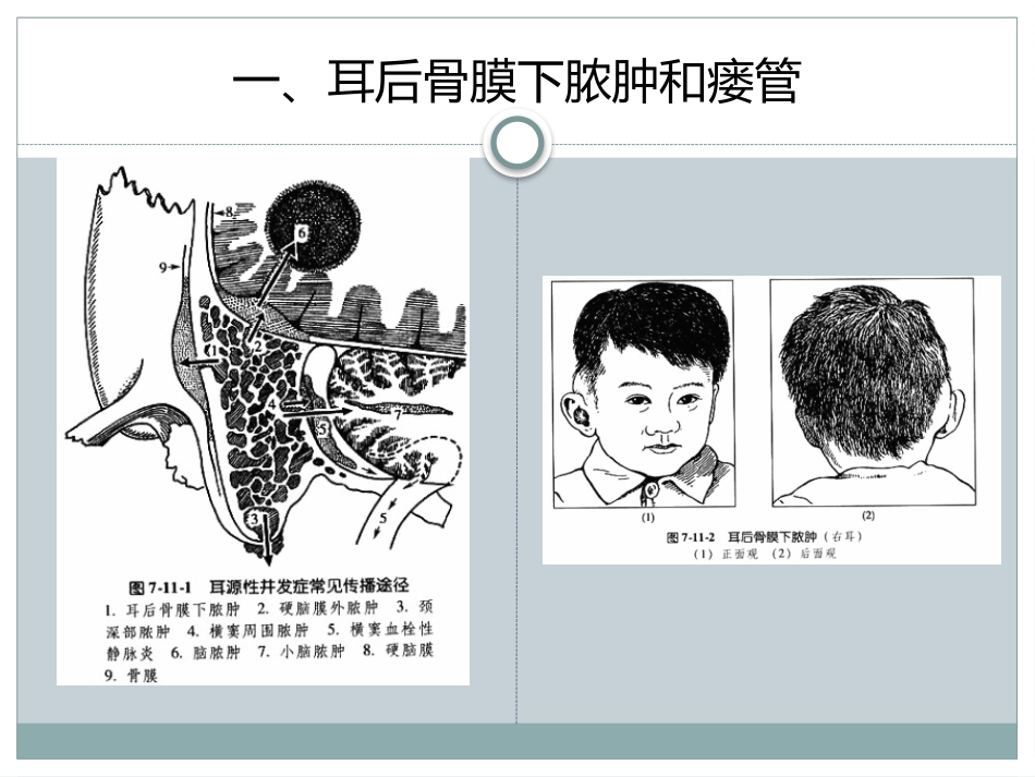 中耳炎颅外并发症_第3页