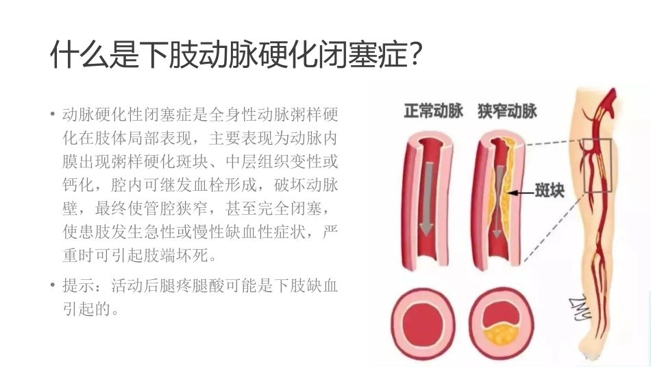 王丽艳(王俪艳)提示中老年腿疼腿酸别忽视-警惕下肢动脉硬化闭塞症_第3页