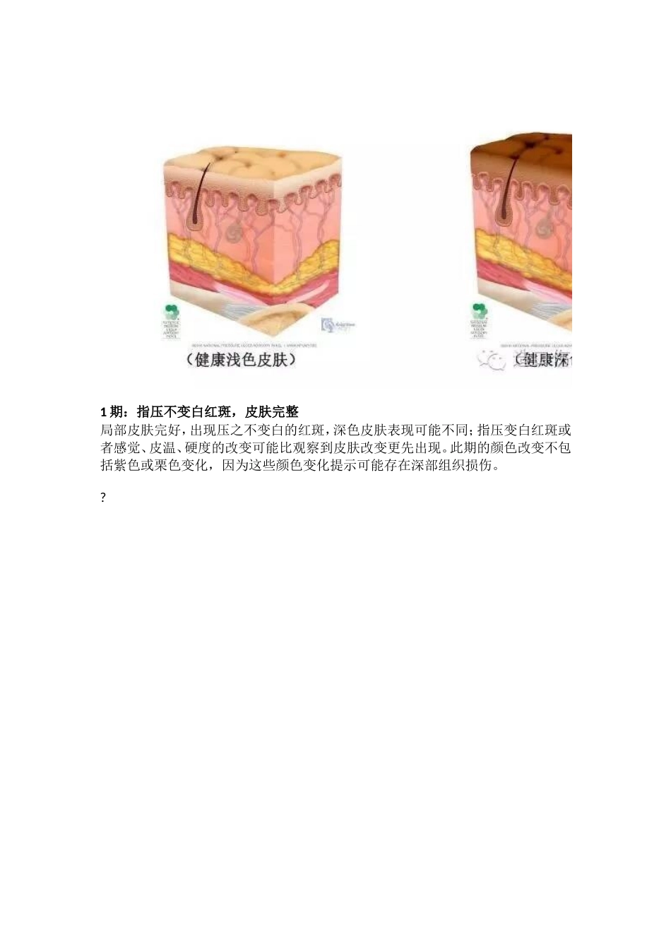 NPUAP最新版压力性损伤定义与分期_第2页