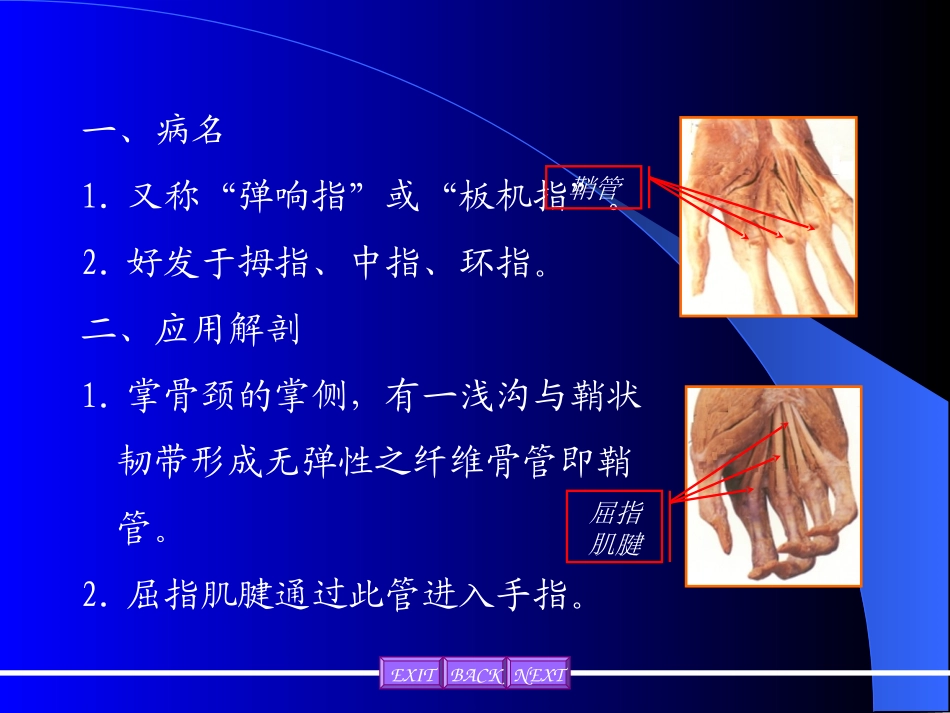 屈指肌腱腱鞘炎_第2页